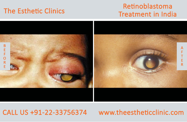 Retinoblastoma Treatment, Retinoblastoma Cancer Surgery before after photos in mumbai india (1)